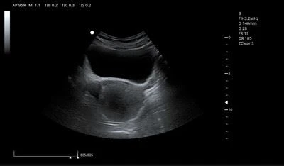 bladder & Uterus_