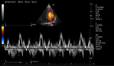 Cardiac PW Mode(001)